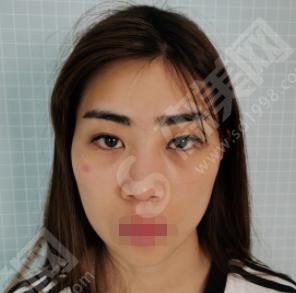 海南人民医院整形科做的双眼皮果如何?附医师介绍及案例分享