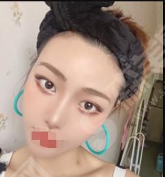 深圳禾丽整形医院做的整形果如何？附医师介绍及案例分享