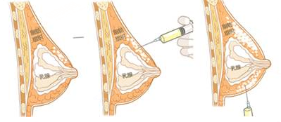 北大深圳医院整形价目表2020,内含胡华新医生的隆胸案例
