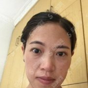 山东省立医院整形价目表2021,内附林莉医生的激光祛斑整形案例