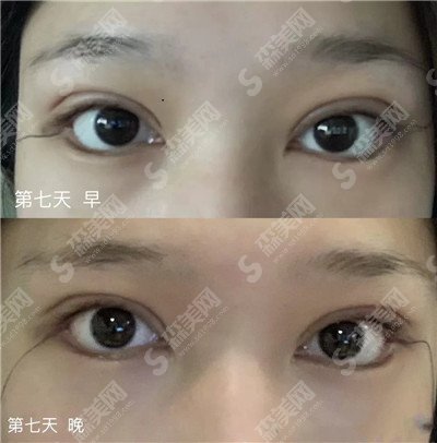 双眼皮的整形价目表2021版一览&内附张峰医生的双眼皮案例果恢复图