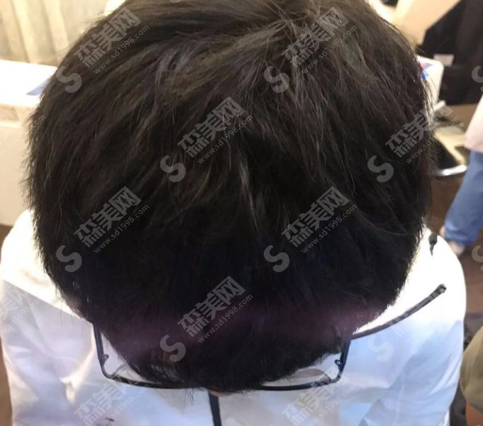 南昌科发源植发医院的植发果好吗?附案例分享/恢复果/植发价格一览表2021