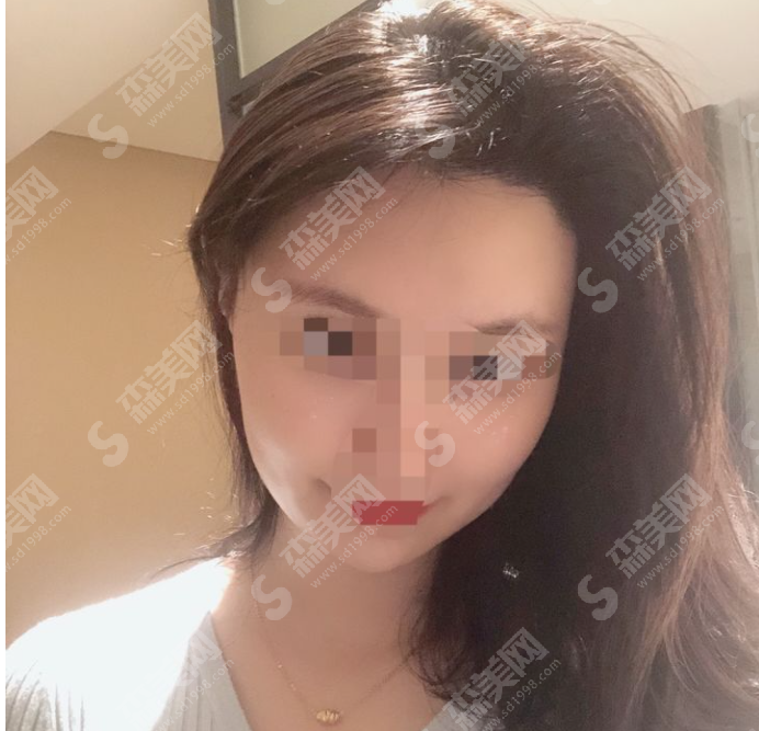 额角植发果怎么样?附案例分享/术后注意事项/恢复果/较新价格一览表