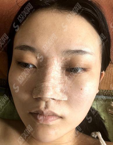 整形医生李博隆鼻技术可以吗?深圳美一度医院/案例展示/个人简介