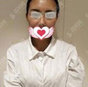 郑州美林苑整形医院价目表2021，内含假体隆鼻恢复详情记录