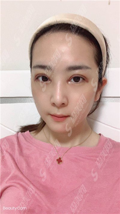 郑州天后整形医院价目表2021,眼部整形怎么样?内附双眼皮手术的恢复果图