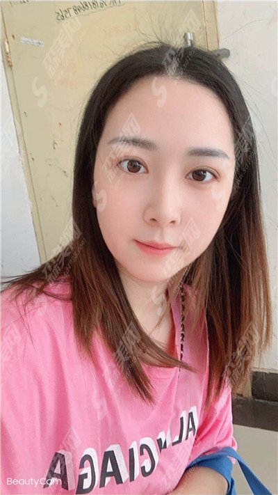 郑州天后整形医院价目表2021,眼部整形怎么样?内附双眼皮手术的恢复果图