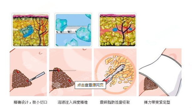 长沙三和整形医生做的腰腹吸脂果好吗？附案例分享/医生简介/吸脂较新价格表