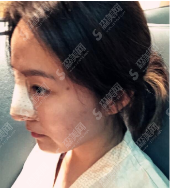耳软骨隆鼻案例分享,耳软骨隆鼻的优势有哪些?附术后注意事项/隆鼻价格一览表2021