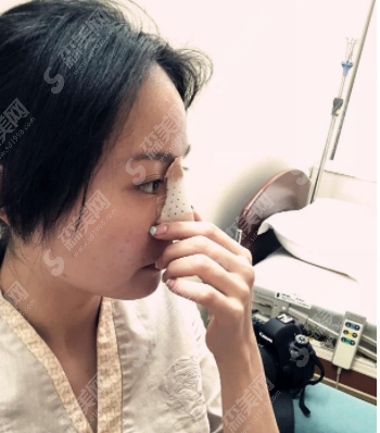 耳软骨隆鼻案例分享,耳软骨隆鼻的优势有哪些?附术后注意事项/隆鼻价格一览表2021