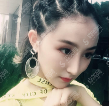 耳软骨隆鼻案例分享,耳软骨隆鼻的优势有哪些?附术后注意事项/隆鼻价格一览表2021