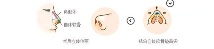 耳软骨隆鼻案例分享,耳软骨隆鼻的优势有哪些?附术后注意事项/隆鼻价格一览表2021