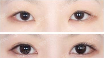 开眼角手术的优势有哪些?开眼角手术的果好吗?术后怎么护理?