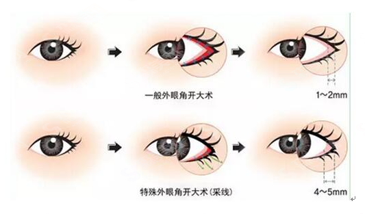 开眼角手术的优势有哪些?开眼角手术的果好吗?术后怎么护理?