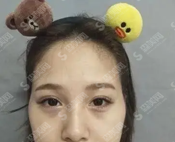 自体脂肪面部填充的果怎么样？附案例分享及整形较新价目表