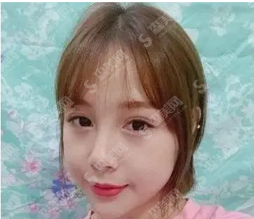 自体脂肪面部填充的果怎么样?附案例分享及整形较新价目表