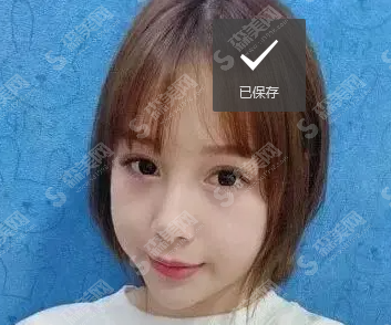 自体脂肪面部填充的果怎么样？附案例分享及整形较新价目表