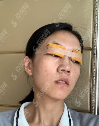 马满仓双眼皮整形手术做的可以吗?美诗沁医院/个人简介/眼部案例