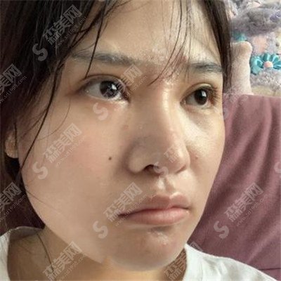 南京柏盛医疗整形价目表2021,隆鼻怎么样?内附硅胶假体隆鼻的较新价目表