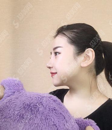 长沙安吉娜整形医院价目表2021,内含自体肋软骨隆鼻术后恢复果展示