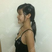 陈亦欣医生隆胸专业吗？铂丽医疗整形医院/口碑如何/隆胸案例