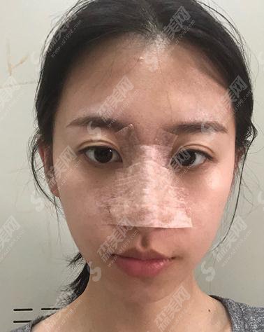 上海容妍整形医院价目表2021,内含假体隆鼻术后详情对比图浏览