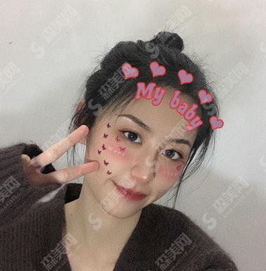 上海容妍整形医院价目表2021,内含假体隆鼻术后详情对比图浏览