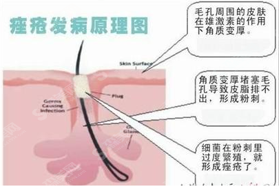 光子嫩肤祛痘的果怎么样？附光子祛痘的护理方法/维持时间/价格表2021