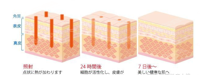 光子嫩肤祛痘的果怎么样？附光子祛痘的护理方法/维持时间/价格表2021
