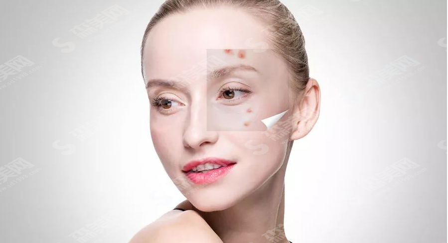 光子嫩肤祛痘的果怎么样？附光子祛痘的护理方法/维持时间/价格表2021