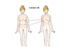 自体脂肪隆胸的果好吗？附案例分享,深圳非凡医院王国民医生简介，隆胸较新价格