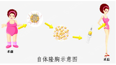 自体脂肪隆胸的果好吗?附案例分享,深圳非凡医院王国民医生简介,隆胸较新价格