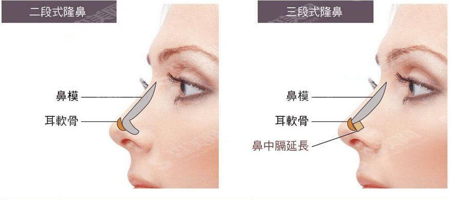 隆鼻手术的注意事项有哪些?隆鼻较新价格2021