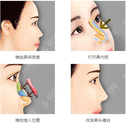 隆鼻手术的注意事项有哪些?隆鼻较新价格2021