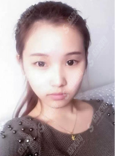 汕头伊丽莎白美容诊所埋线双眼皮做的好吗?附医院介绍/案例分享/双眼皮较新价格