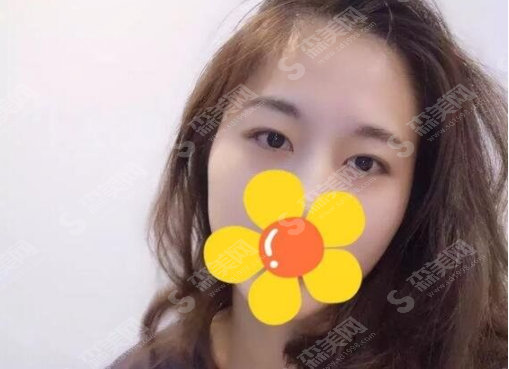 吸雕双眼皮果怎么样?吸雕双眼皮案例分享及术后注意事项,内含双眼皮价格一览表2021