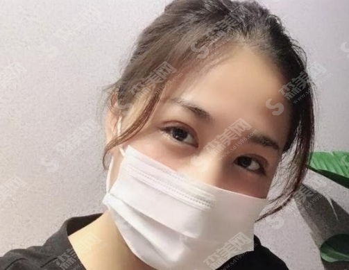吸雕双眼皮果怎么样?吸雕双眼皮案例分享及术后注意事项,内含双眼皮价格一览表2021