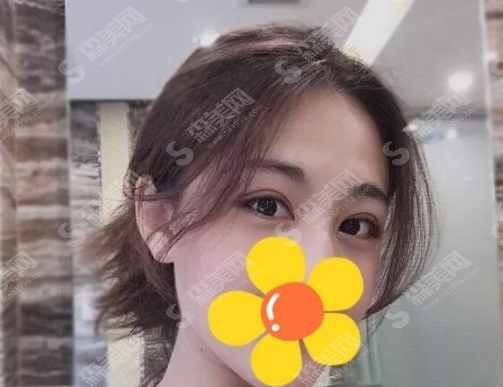 吸雕双眼皮果怎么样?吸雕双眼皮案例分享及术后注意事项,内含双眼皮价格一览表2021