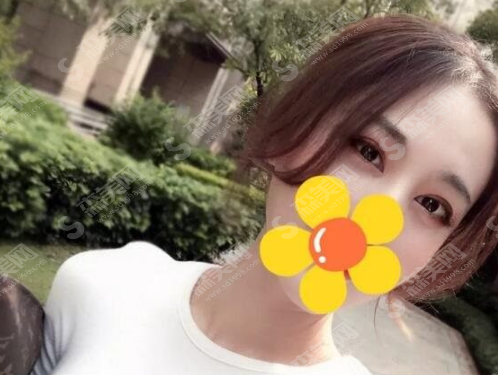 吸雕双眼皮果怎么样?吸雕双眼皮案例分享及术后注意事项,内含双眼皮价格一览表2021