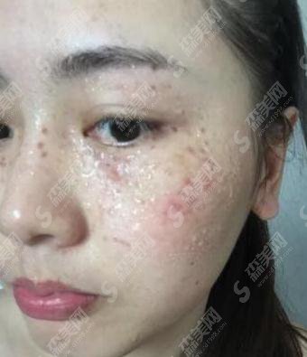 石家庄省二院激光祛斑价目表2021,内含祛斑案例分享