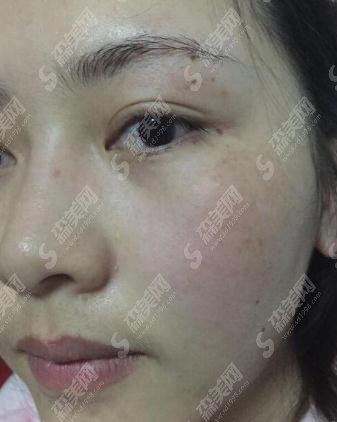 石家庄省二院激光祛斑价目表2021,内含祛斑案例分享