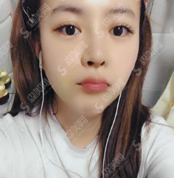 石家庄省二院激光祛斑价目表2021,内含祛斑案例分享