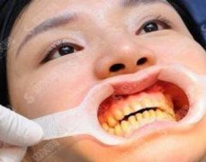 南昌维乐口腔医院价目表2021，内含牙齿美白案例分享＋术后果