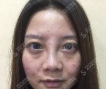 长春吉大一院点阵激光做得可以吗？激光祛斑案例展示＋2021较新价格表