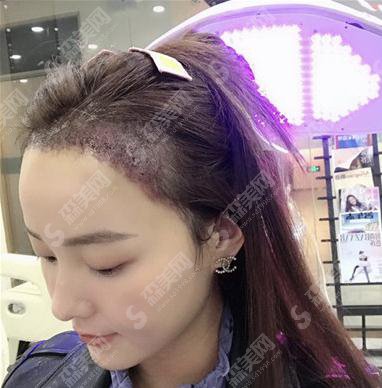 上海ido整形医院价目表2021,内含种植发际线术后果展示