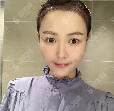 上海ido整形医院价目表2021,内含种植发际线术后果展示