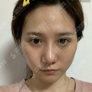 北京基恩医院医疗美容院价目表2021,面部填充怎么样?内附脂肪填充面部的整形果图