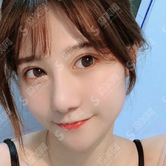 北京基恩医院医疗美容院价目表2021,面部填充怎么样?内附脂肪填充面部的整形果图