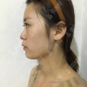 西安汉唐整形医院价目表2021,隆鼻技术怎么样?内附硅胶假体隆鼻的整形价目表