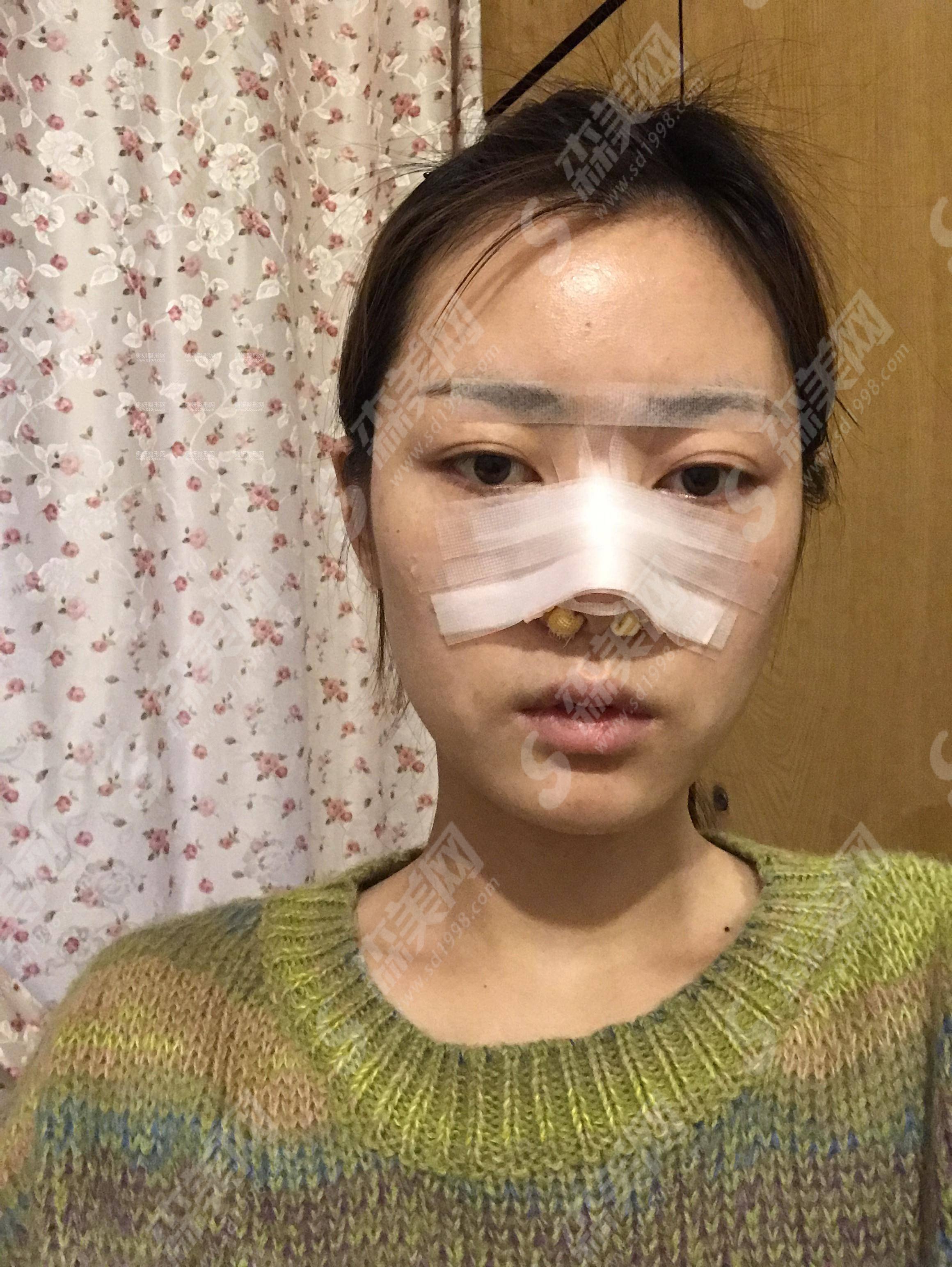 西安汉唐整形医院价目表2021,隆鼻技术怎么样?内附硅胶假体隆鼻的整形价目表